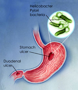 pylori helicobacter stomach symptoms infektion
